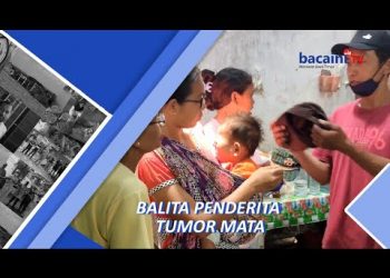 Balita Penderita Tumor Mata