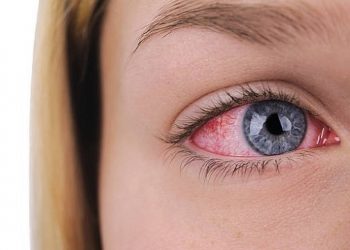 Waspada Wabah Penyakit Mata Merah