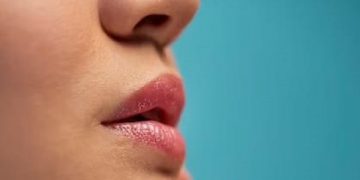 5 Cara Alami Mengatasi Bibir Kering dan Pecah-pecah