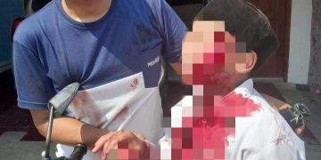 Luka Sayat Pada Wajah Bocah SD di Malang Diduga Tak Sengaja. (foto/ist)