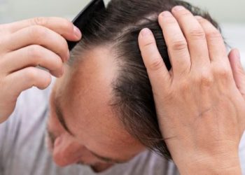 Atasi Ancaman Kebotakan dengan Mengetahui Solusi Ini