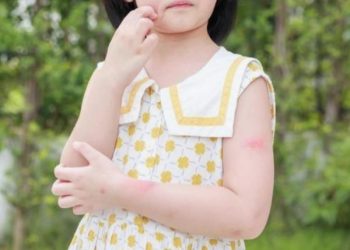 Mengenal Sebab dan Reaksi Alergi yang Bisa Renggut Nyawa