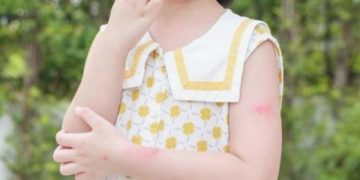 Mengenal Sebab dan Reaksi Alergi yang Bisa Renggut Nyawa. (foto ilustrasi/vecteezy)