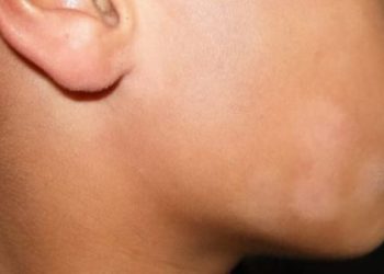 Misteri Belang Kulit Muka, Bukan Jamur Tapi Bikin Tak Pede