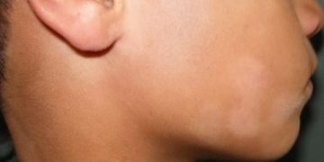 Misteri Belang Kulit Muka, Bukan Jamur Tapi Bikin Tak Pede (foto ilustrasi/Instagram)